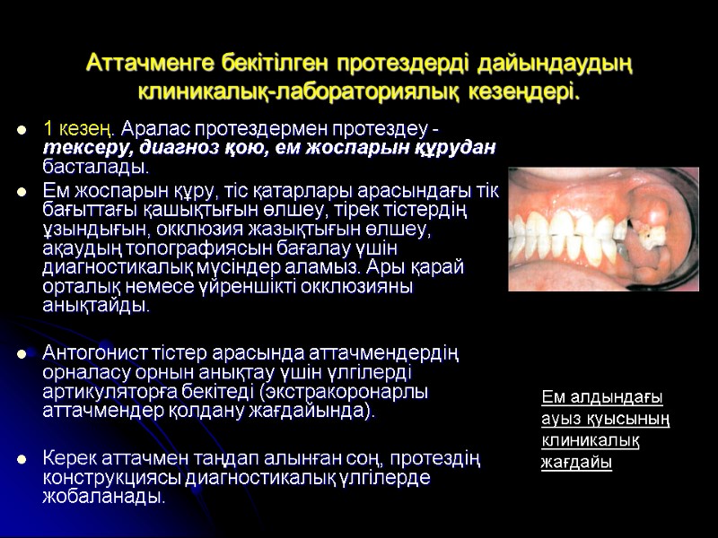Аттачменге бекітілген протездерді дайындаудың клиникалық-лабораториялық кезеңдері. 1 кезең. Аралас протездермен протездеу -  тексеру,